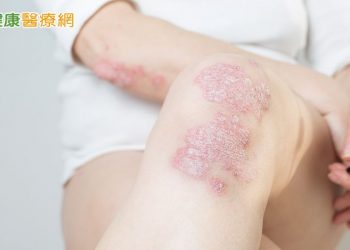 全身牛皮癬苦不堪言　高療效生物製劑治療走出新人生