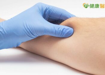脂肪瘤需要切除嗎？　專科醫列「3條件」