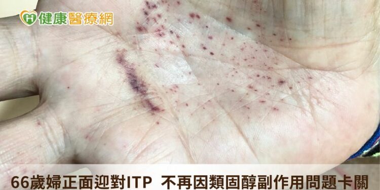 66歲婦正面迎對itp　不再因類固醇副作用問題卡關