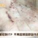 66歲婦正面迎對itp 不再因類固醇副作用問題卡關