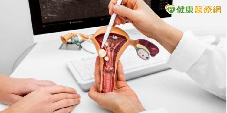 子宮肌瘤合併卵巢瘤　「單孔腹腔鏡微創手術」解困擾
