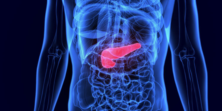 癌王又發威! 胰臟癌9成患者一年就喪命