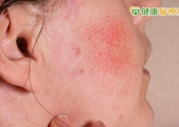 玫瑰斑、酒糟肌-換季保養攻略