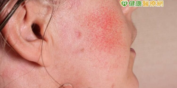 玫瑰斑、酒糟肌-換季保養攻略