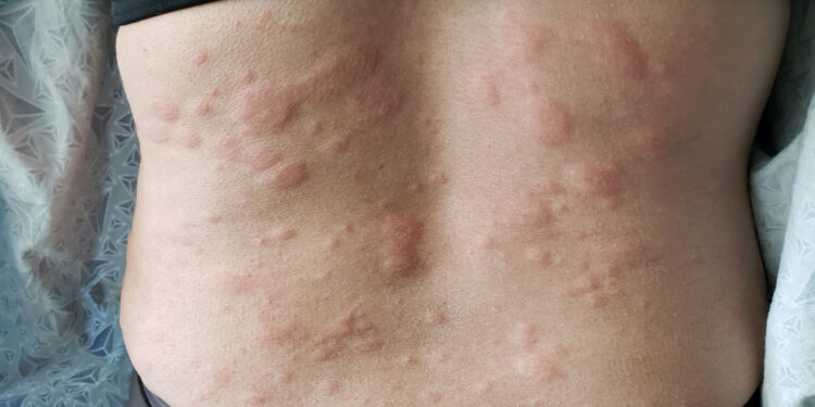 蕁麻疹吃什麼都過敏? 營養師:避6類含組織胺食物