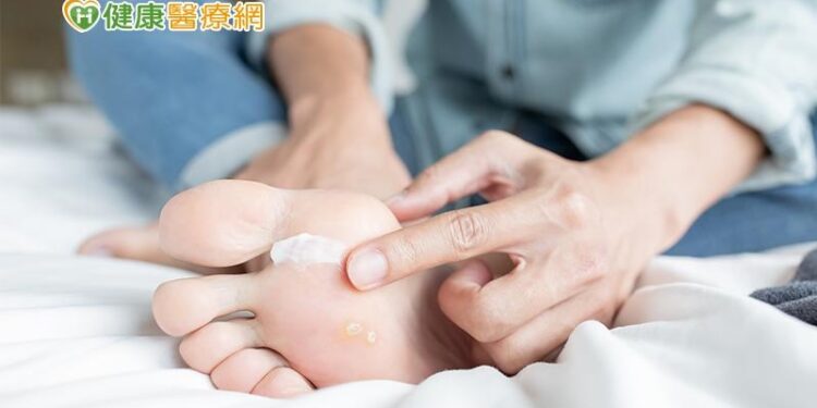 梅雨讓你「香港腳」復發了嗎?醫師:康復後繼續擦藥1~2週