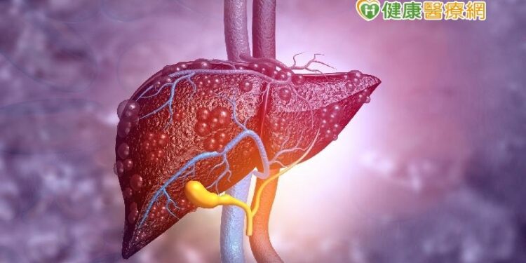 擔心罹肝癌?醫:「這4種檢查」極小腫瘤都能測