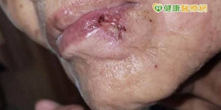 突然長「痣」莫輕忽 當心皮膚癌