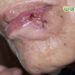 突然長「痣」莫輕忽 當心皮膚癌