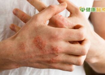 乾癬患者小心腸道症狀　罹患大腸癌風險增加
