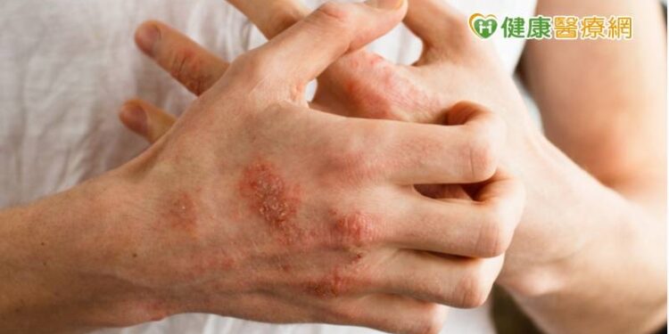 乾癬患者小心腸道症狀 罹患大腸癌風險增加
