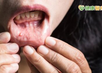 嘴破以為火氣大？　15年檳榔族「口腔癌」找上門
