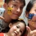 6歲兒臉長太田母斑遭嘲諷 父母畫臉伴面對異樣眼光