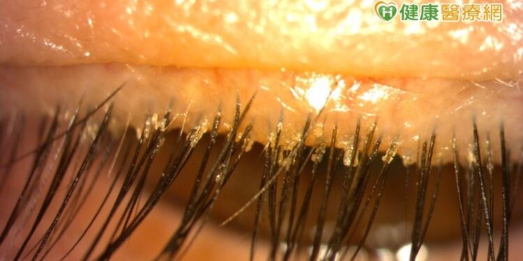 眼紅反覆長針眼別輕忽,醫警告:恐是睫毛有蟎蟲寄生!