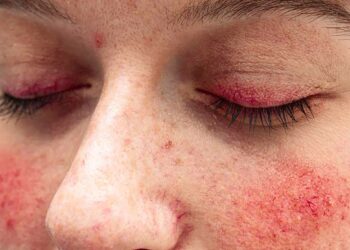 響應「2023國際玫瑰斑月」一起來重視玫瑰斑